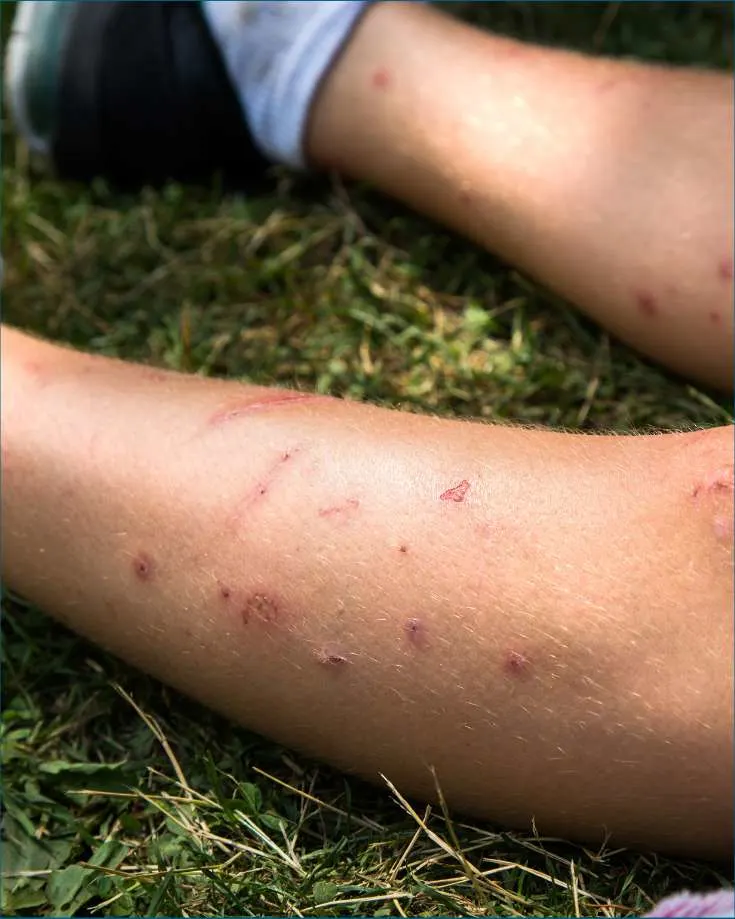 A close up of irritating mosquito bites on a camper's bare legs